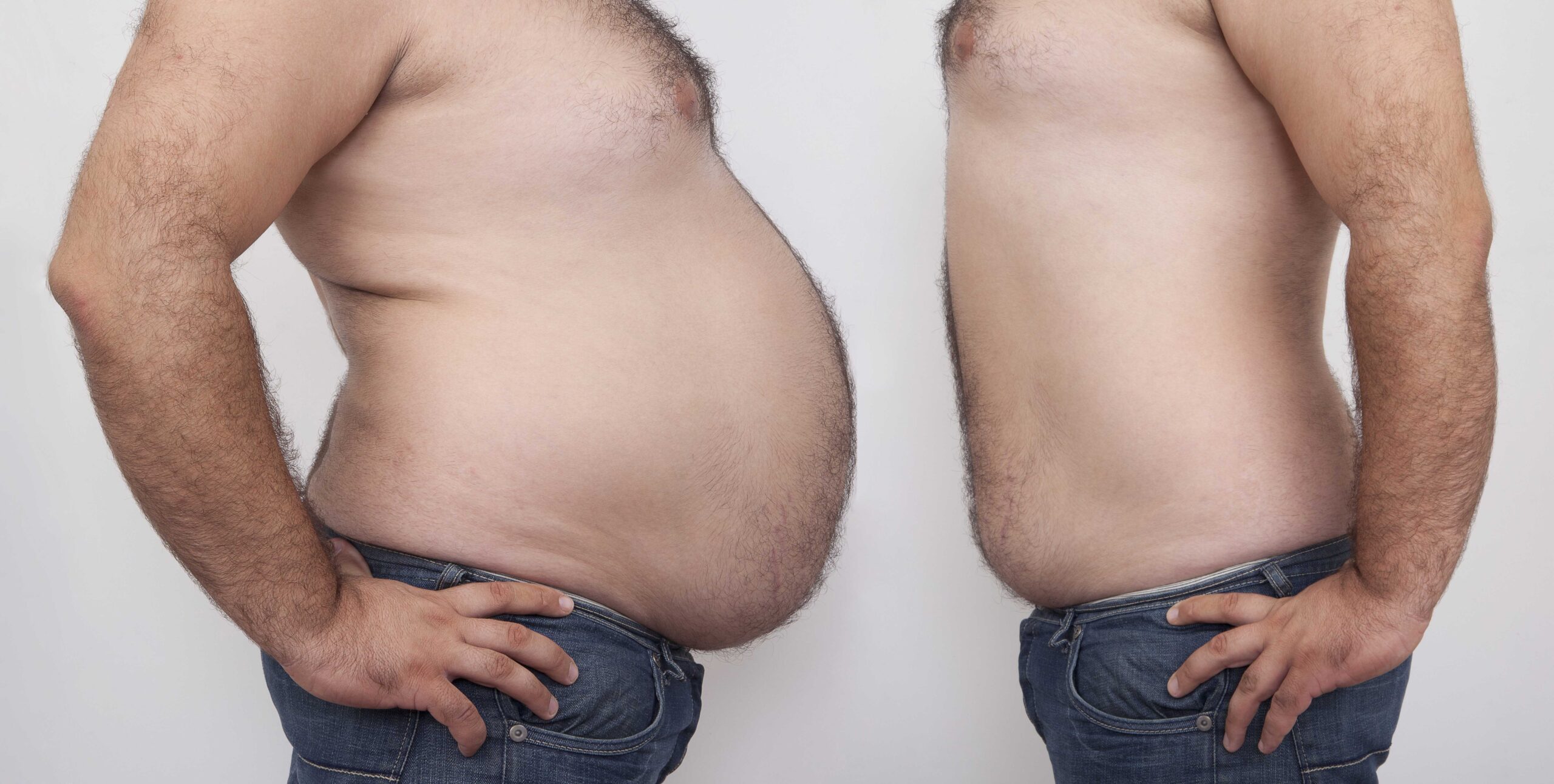 before and after comparison of a man who received body contouring surgery after weight loss
