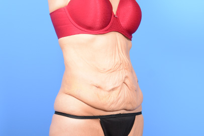 Tummy Tuck Before and After Photo Gallery, Albany & Latham, New York