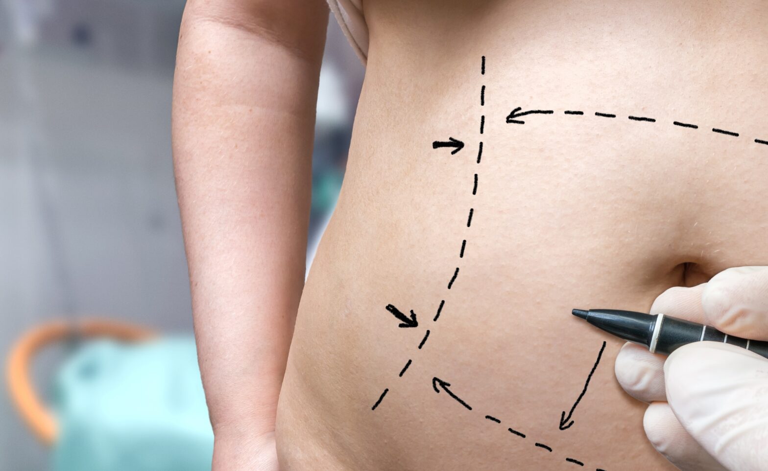 tummy tuck markings on abdomen