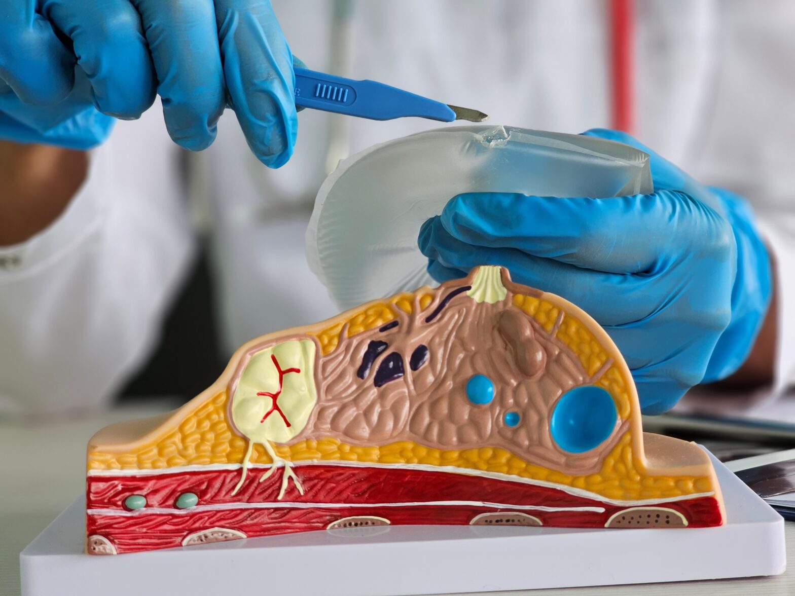 doctor examining breast implant for revision surgery