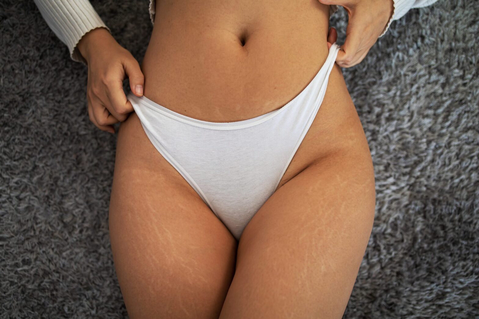 Eliminating Stretch Marks Once and For All With Fraxel!